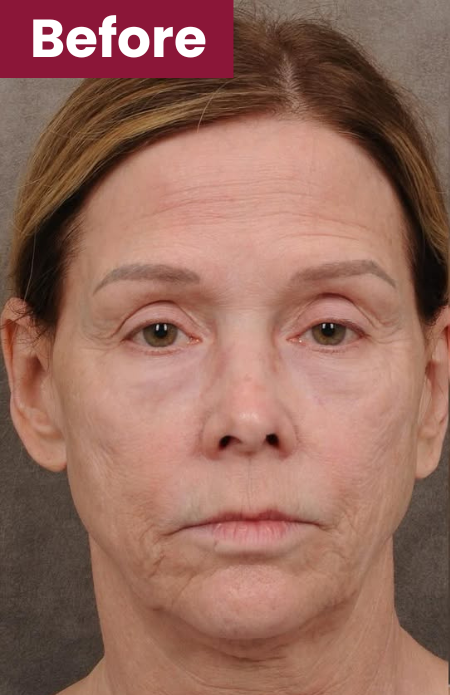 Anti-Wrinkle Collagen Mask 34 After 3